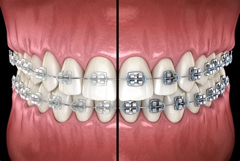 brackets de ceramica vs metal|Ceramic vs Metal Braces: 2 Ultimate Options To .